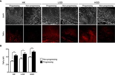 TNFα Signaling Is Increased in Progressing Oral Potentially Malignant Disorders and Regulates Malignant Transformation in an Oral Carcinogenesis Model